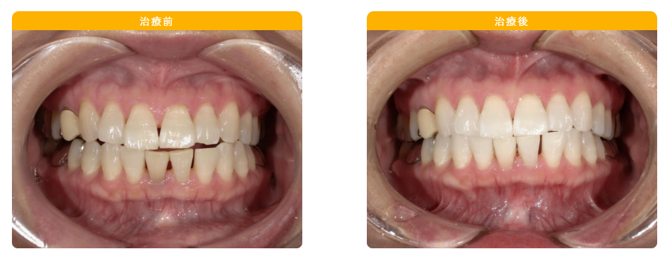 ホワイトニングの症例